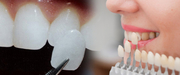 Dental Veneers to Fix Chipped & Discolored Front Teeth