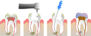 Root Canal Treatment for Infected Tooth