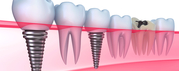 Dental Implants Can Help You Chew Again
