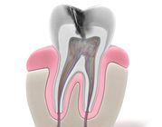 Root Canal Treatment Dentistry