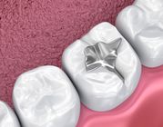 Dental Sealants Care Calgary NE