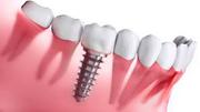 Canada's Most Trusted Dental Implant Clinic - Why Patients Choose Us